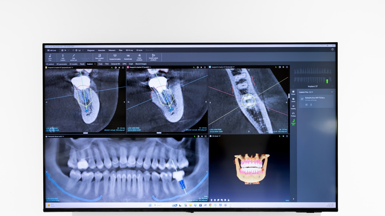 Dentist explaining wisdom teeth assessment results on a tablet
